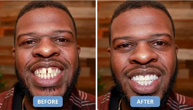Before and after — man's smile transformed with clip-in veneers