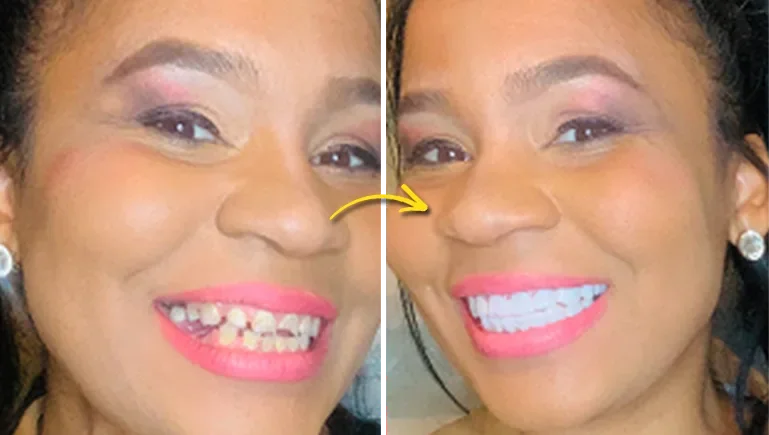 Before and after photo of a reader's smile after using clip-in veneers